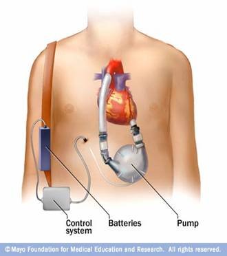 heart_pumps heart_pumps